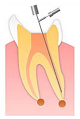 根管治療